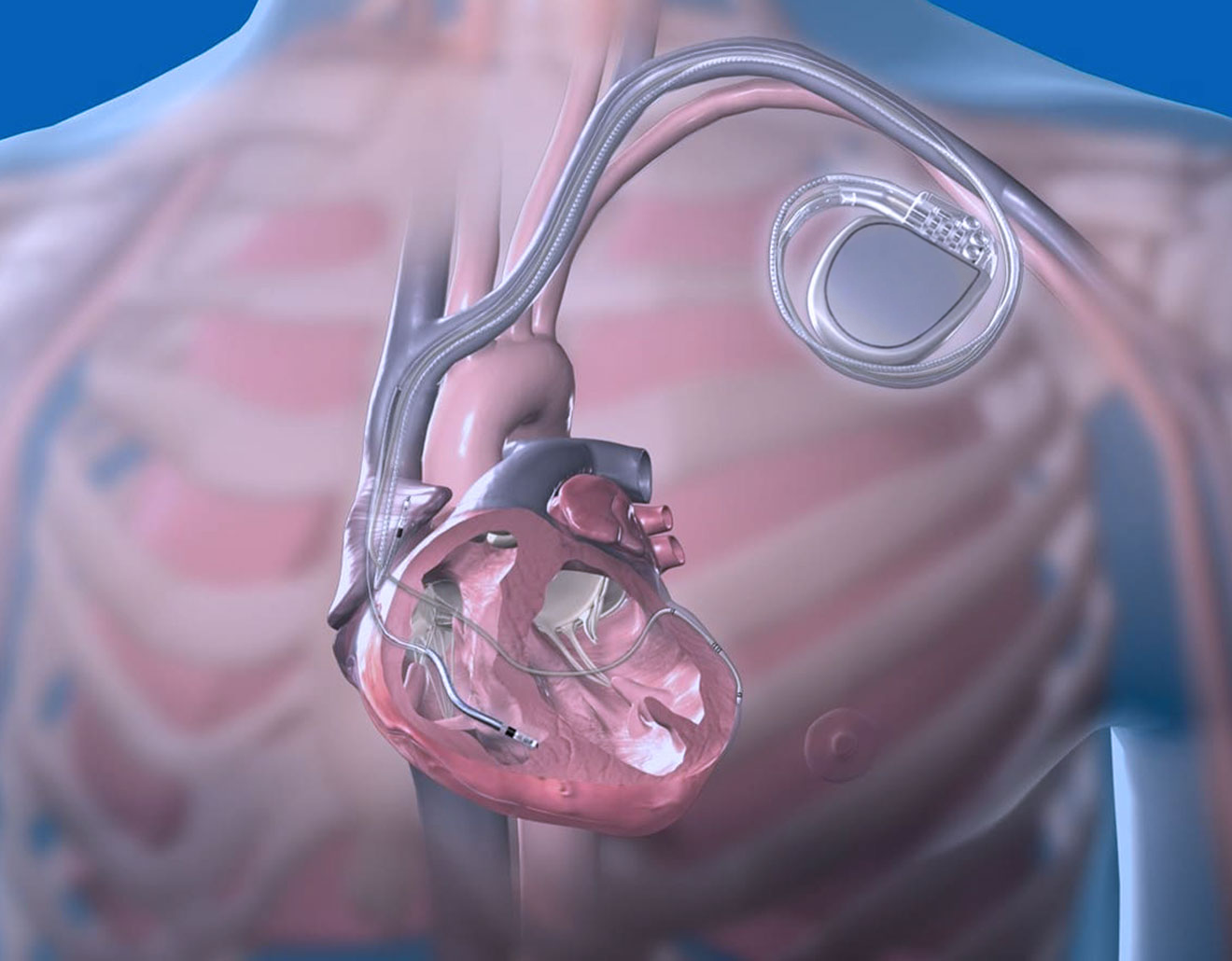 ICD-Implantation (implantierbarer Cardioverter Defibrillator)