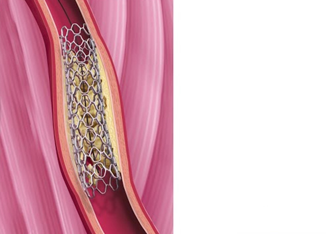 Ballondilatation und Stenting