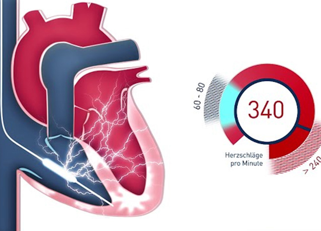 Defibrillator (ICD)