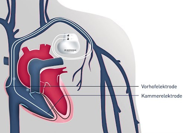 Herzschrittmacher