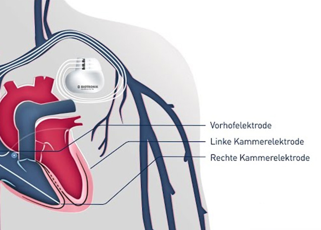 CRT-Therapie bei Herzschwäche