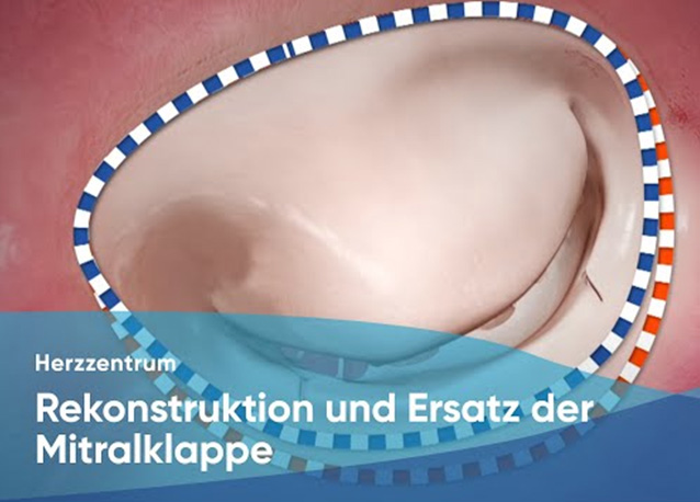 Rekonstruktion und Ersatz der Mitralklappe