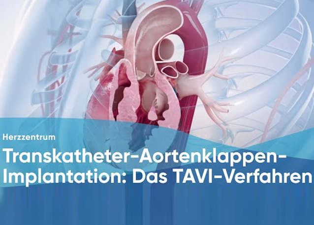 Transkatheter-Aortenklappen-Implantation: Das TAVI-Verfahren